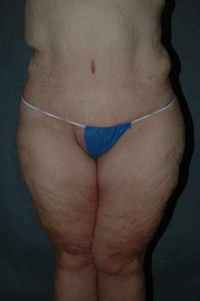 BELT LIPECTOMY Before and After Results