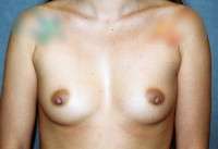 Breast Augmentation