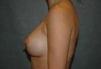 Breast Augmentation