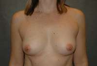 Breast Augmentation