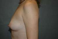 Breast Augmentation