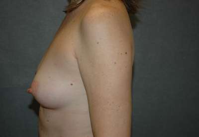 Breast Augmentation