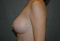 Breast Augmentation