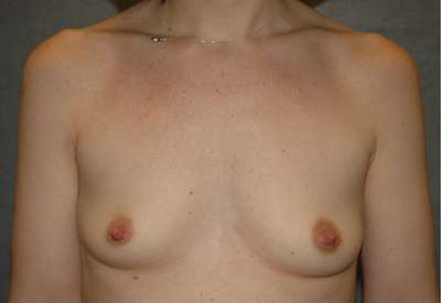 Breast Augmentation Case 4468 Before Photo Breast Augmentation