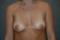 Breast Augmentation