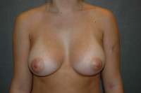 Breast Augmentation