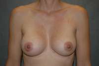 Breast Augmentation