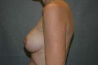 Breast Augmentation