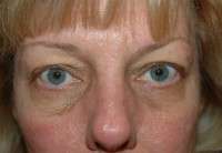 Eyelid Lift