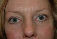 Eyelid Lift