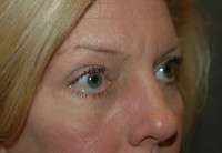 Eyelid Lift