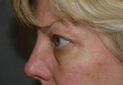 Eyelid Lift