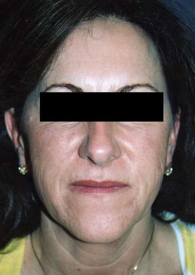 Facelift Case 4520 Before Photo Facelift