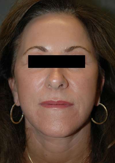 Facelift Case 4520 After Photo Facelift
