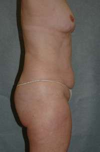 Abdominoplasty