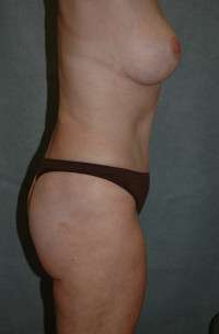 Abdominoplasty