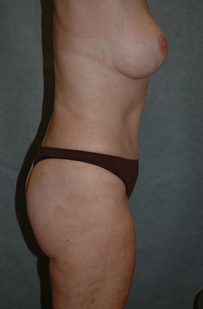 Abdominoplasty