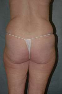 Abdominoplasty