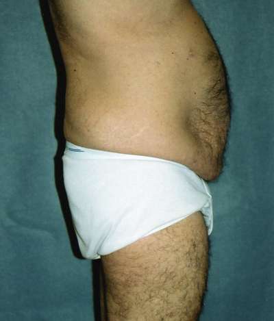 Male Belt Lipectomy