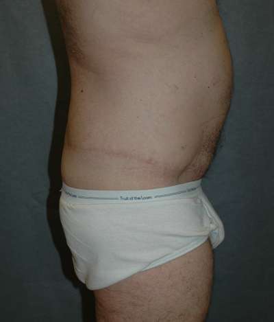 Male Belt Lipectomy