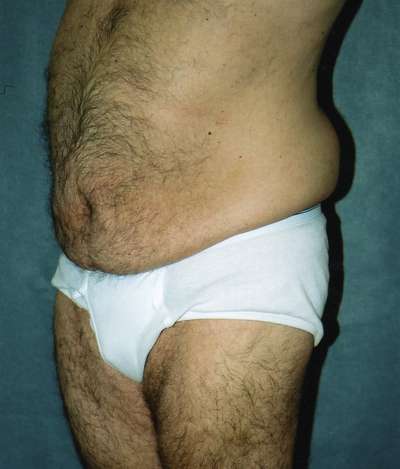 Male Belt Lipectomy
