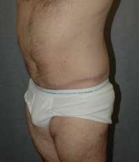 Male Belt Lipectomy