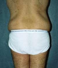 Male Belt Lipectomy
