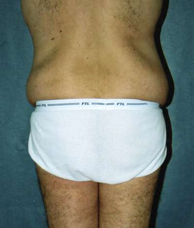Male Belt Lipectomy