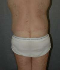 Male Belt Lipectomy