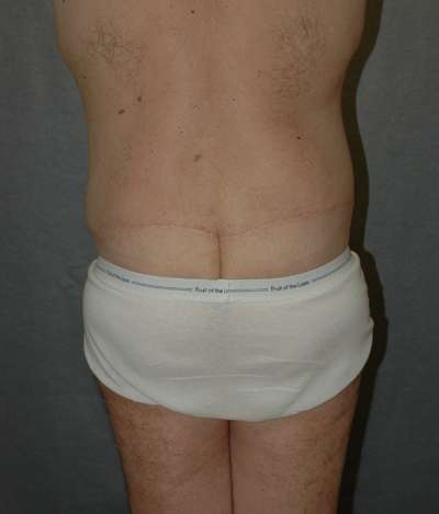 Male Belt Lipectomy