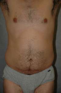 Male Liposuction