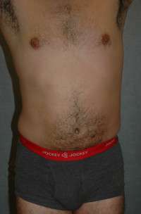 Male Liposuction