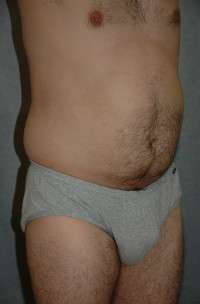 Male Liposuction