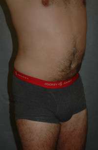 Male Liposuction