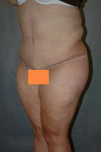 Belt Lipectomy