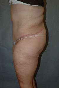 Belt Lipectomy