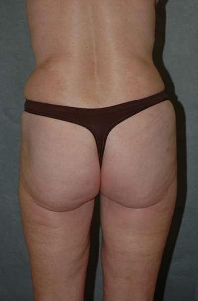 Abdominoplasty