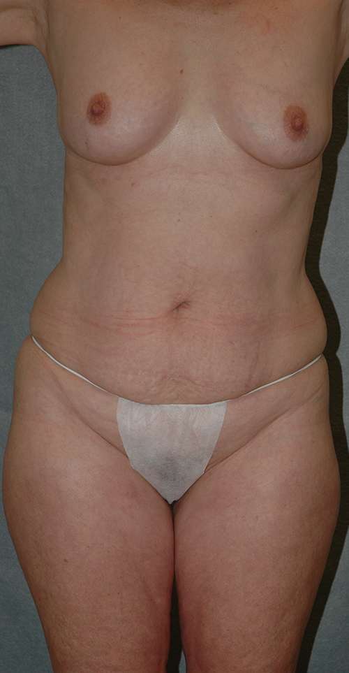 Abdominoplasty