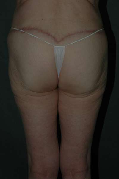 Belt Lipectomy Case 5019 After Photo Belt Lipectomy