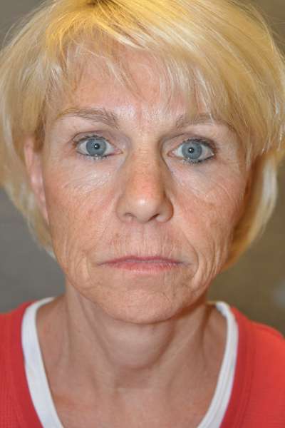 Facelift Case 5025 Before Photo Facelift