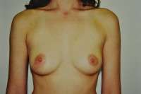 Breast Augmentation