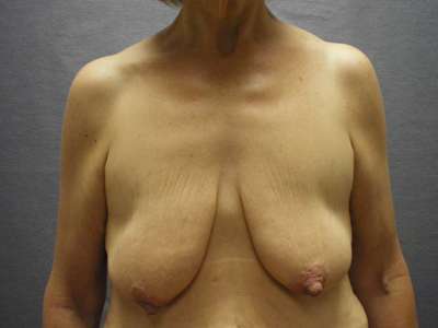 Breast Lift