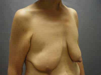 Breast Lift