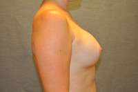 Breast Augmentation