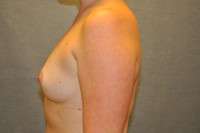 Breast Augmentation