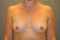 Breast Augmentation