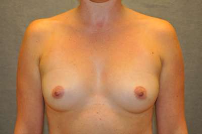 Breast Augmentation