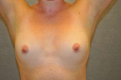 Breast Augmentation