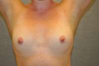 Breast Augmentation