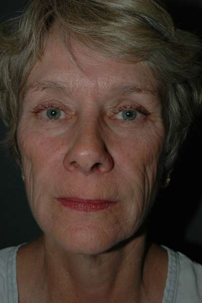 Eyelid Lift Case 5138 Before Photo Eyelid Lift